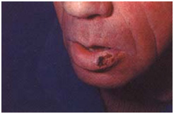 Герпес на губах: фото и симптомы